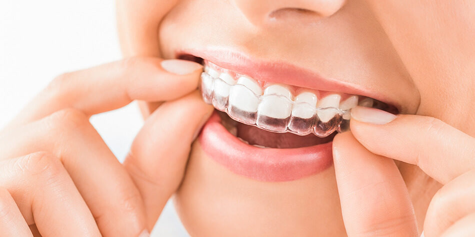 Invisalign First: o aparelho dental para crianças mais confortável,  discreto e eficiente do mundo - Barini Odontologia
